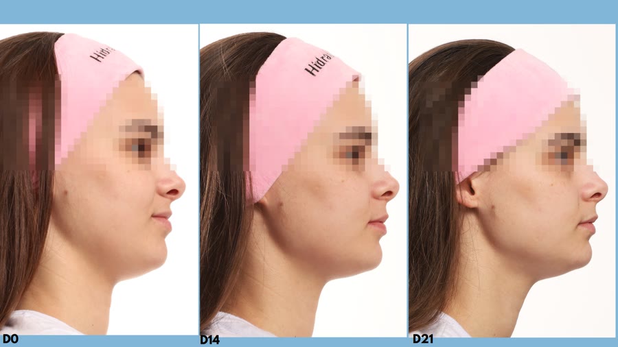 Montagem com três fotos de perfil do rosto de uma mulher de blusa branca e faixa de cabelo Hidrabene, comparando o contorno do rosto e a papada em D0, D14 e D21