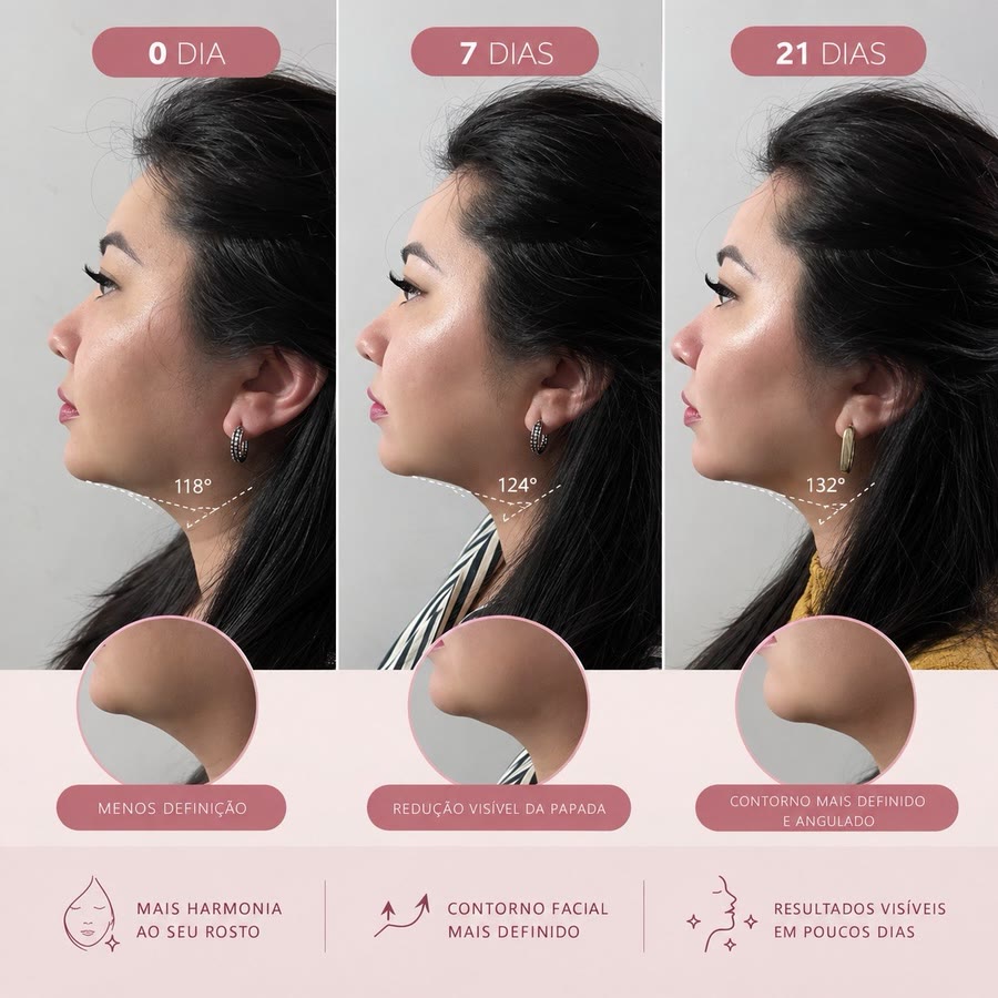 Colagem com três fotos de perfil do rosto de uma mulher, comparando o contorno do queixo e do pescoço em 0 dia, 7 dias e 21 dias: ângulos de 118°, 124° e 132°, com as legendas menos definição, redução visível da papada e contorno mais definido e angulado